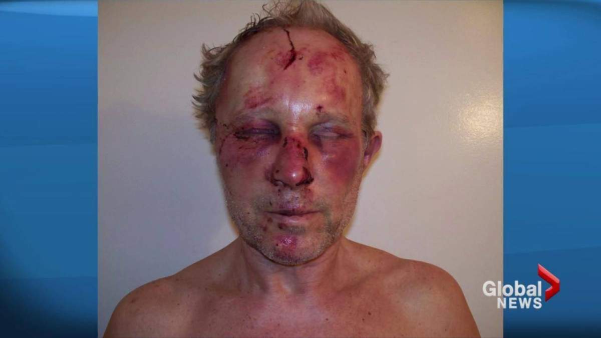 Vladimir Tchaikoun and the injuries he sustained during an altercation with two VPD officers in 2016.