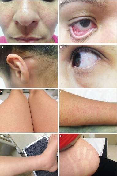 Panel A shows a maculopapular rash on the face; Panel B, conjunctival and palpebral erythema; Panel C, retroauricular lymphadenopathy; Panel D, conjunctival injection with prominence of vasculature; Panel E, a rash on the legs, with a lacy reticular pattern; Panel F, a maculopapular rash on the inner arm; Panel G, edema of the foot, which the patient reported was painful; and Panel H, a blanching macular rash on the gravid abdomen.