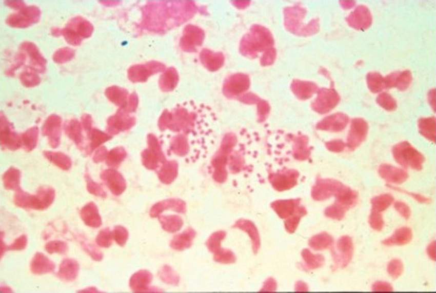Ontario’s rising gonorrhea rate is driven almost entirely by an increase in cases among men, data shows. 