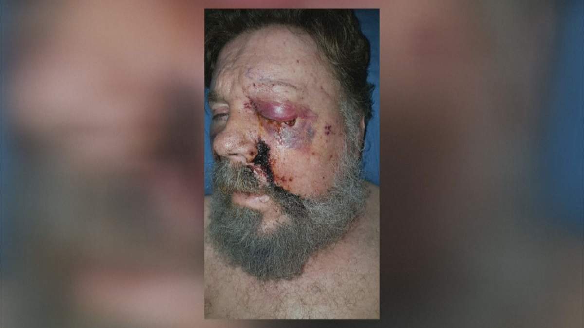 California man loses eye in e-cigarette explosion - image
