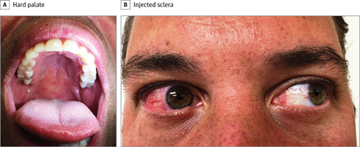 These are the tell-tale symptoms of Zika virus, according to new case study - image