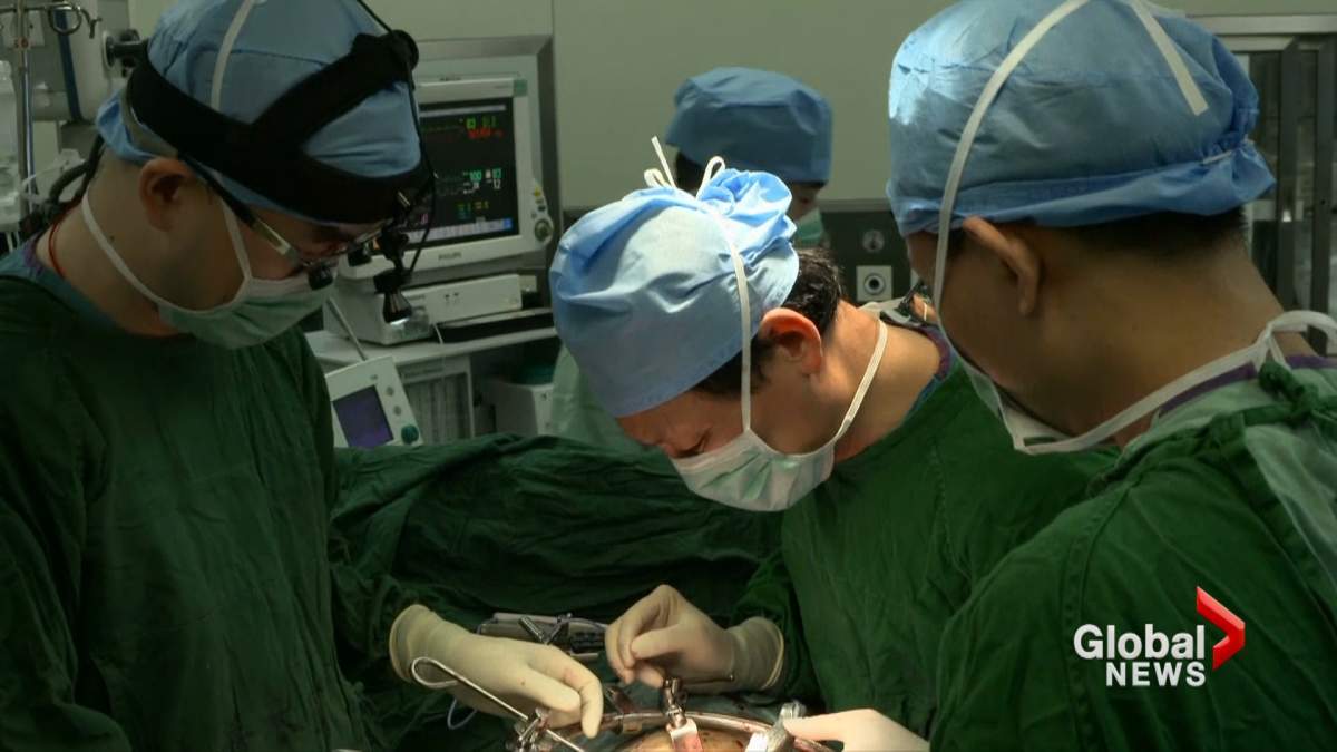1st successful 3D printed spinal implant operation conducted in China - image