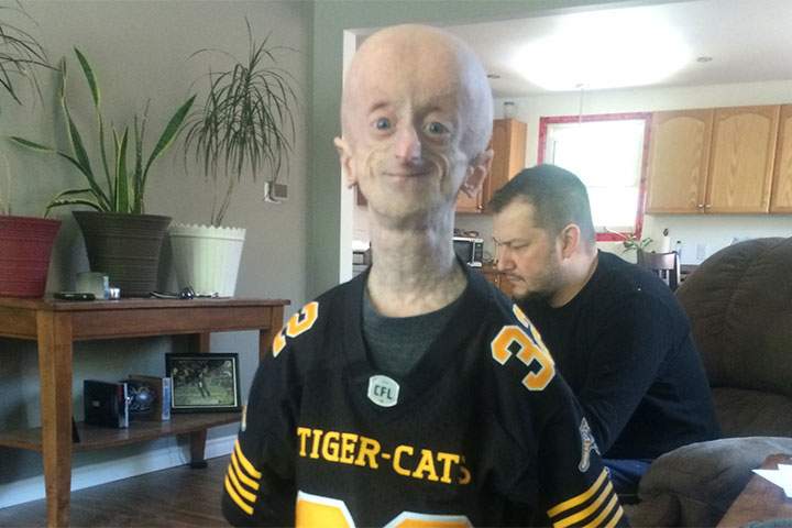 Hamilton teen with rare aging disorder vows to ‘keep fighting’ - image