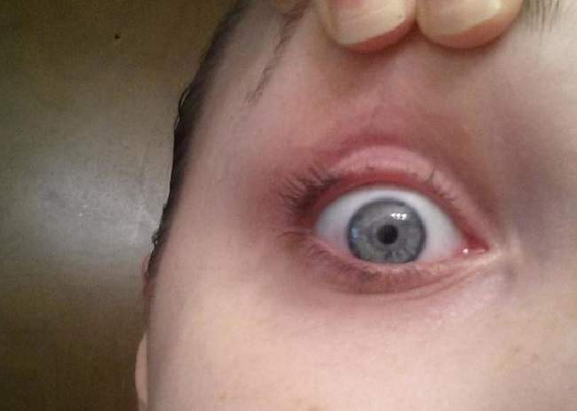 Eyelash curler nightmare: Woman’s sneeze leaves her lashless - image