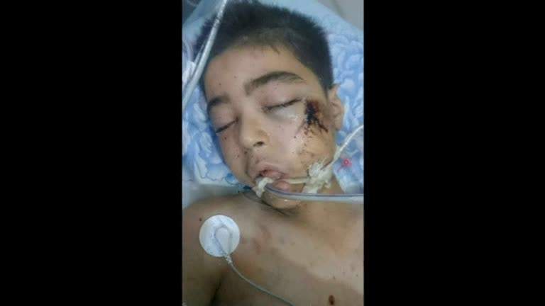 The older brother of a Syrian boy whose image, dazed and bloodied after an air strike in Aleppo, shocked people around the world, has died of his wounds, the doctor who treated him said.
