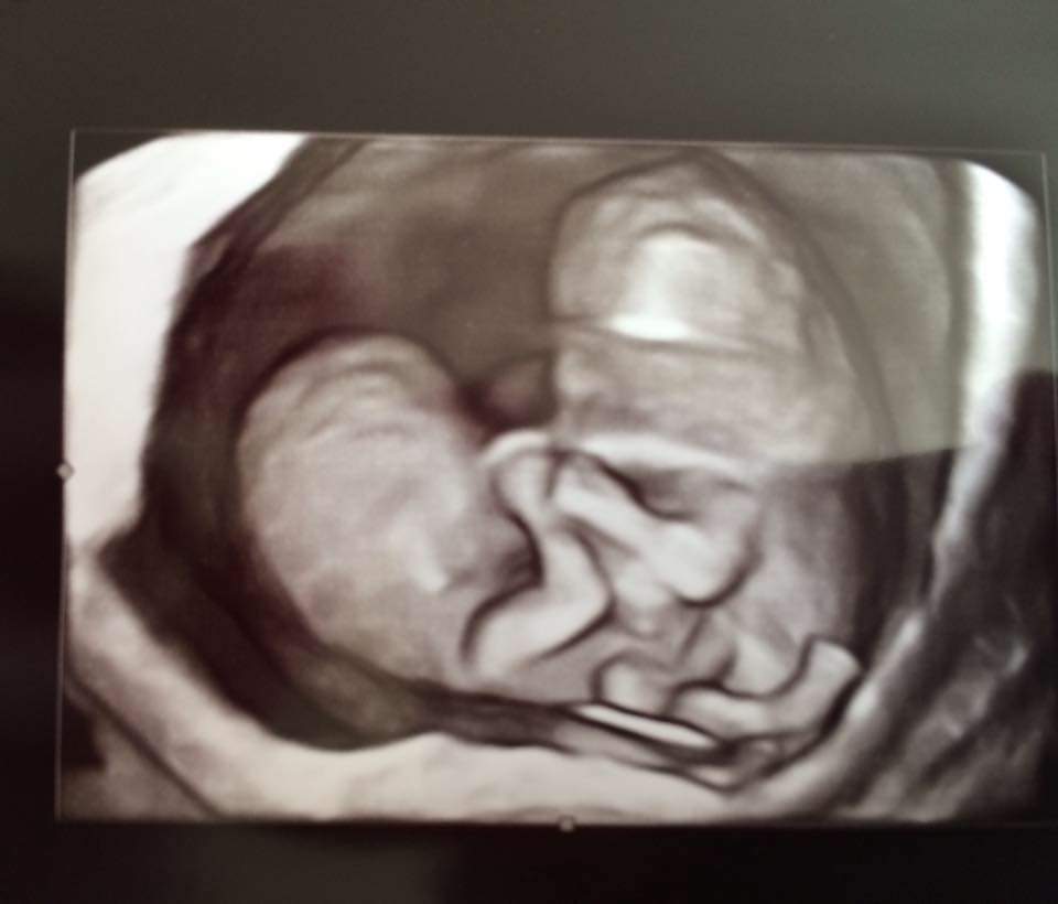 After seeing this image, doctors delivered fateful news to expectant mom Chelsea Torres: she was having conjoined twins.