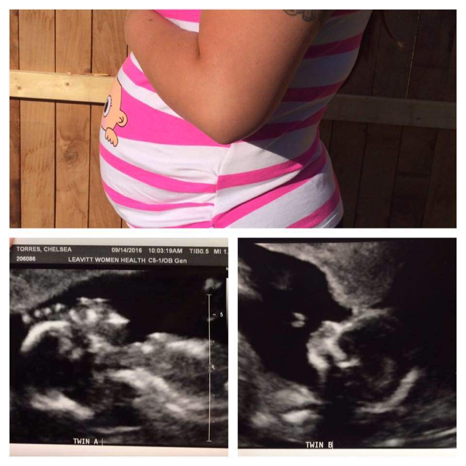 ‘I knew something was wrong’: Couple learns they’re having conjoined twins in ultrasound image - image