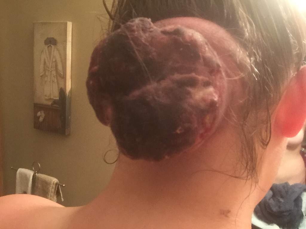 The alleged cyst had grown in size and constantly bled.