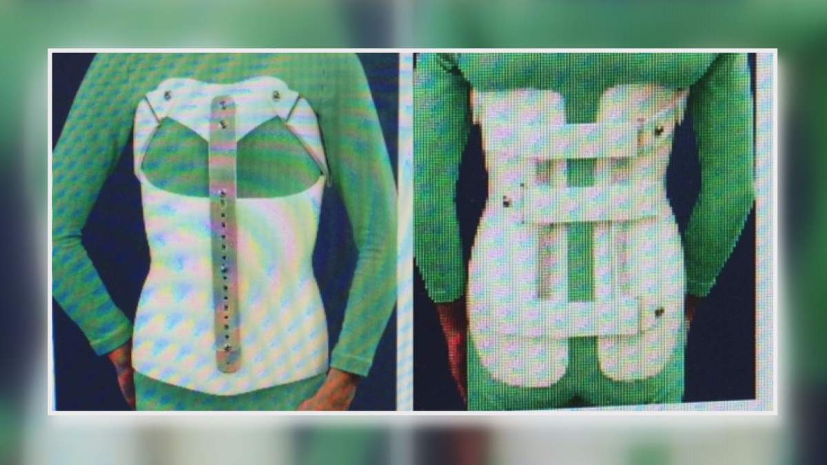 Saskatoon family travels overseas for modern back brace option for son - image
