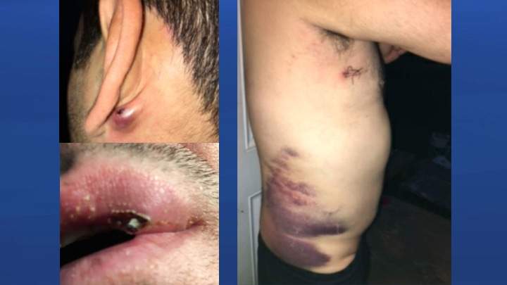 Clayton Prince supplied photos to Global News of the injuries he said he received in a violent police arrest.