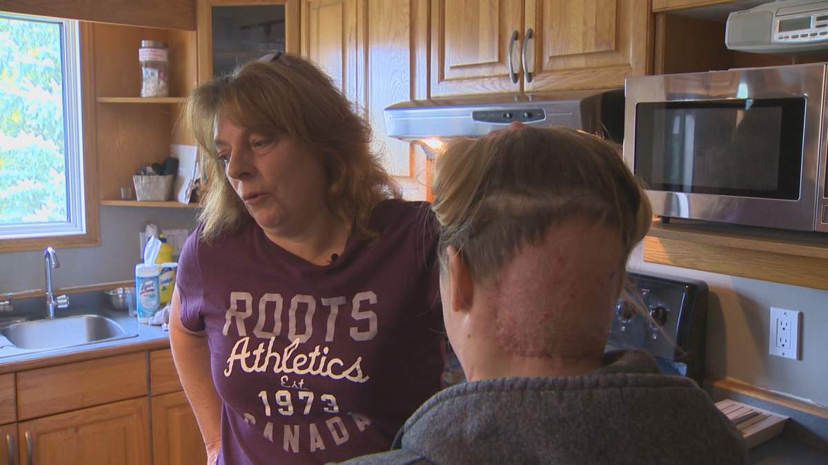 Rachael Sawka (right) shows the remnants of surgery after a tumour was removed. 