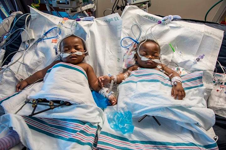 In this Nov. 8, 2016 photo provided by the Le Bonheur Children’s Hospital, twins from Nigeria, Miracle and Testimony Ayeni, rest after being separated at Le Bonheur Children’s Hospital in Memphis, Tenn. The girls were conjoined at the lower half of the body and separated following about an 18-hour procedure.