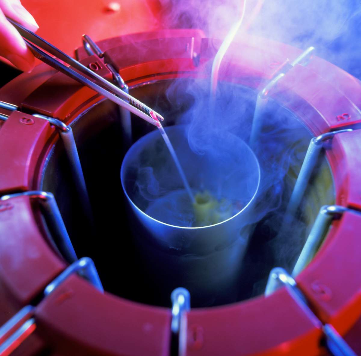 Sperm bank. Samples of cryogenically stored sperm being removed from the storage tank. This container is filled with liquid nitrogen, which keeps its contents at almost -200 degrees Celsius. After a sample is removed and thawed, the most healthy sperm cells are selected by a computer imaging system and then used for in vitro fertilisation (IVF) to treat infertile couples. Storage of frozen sperm can preserve a man’s ability to have children if his fertility is threatened by cancer of the testis. Use of sperm from an anonymous donor can also help couples where only the male partner is infertile.