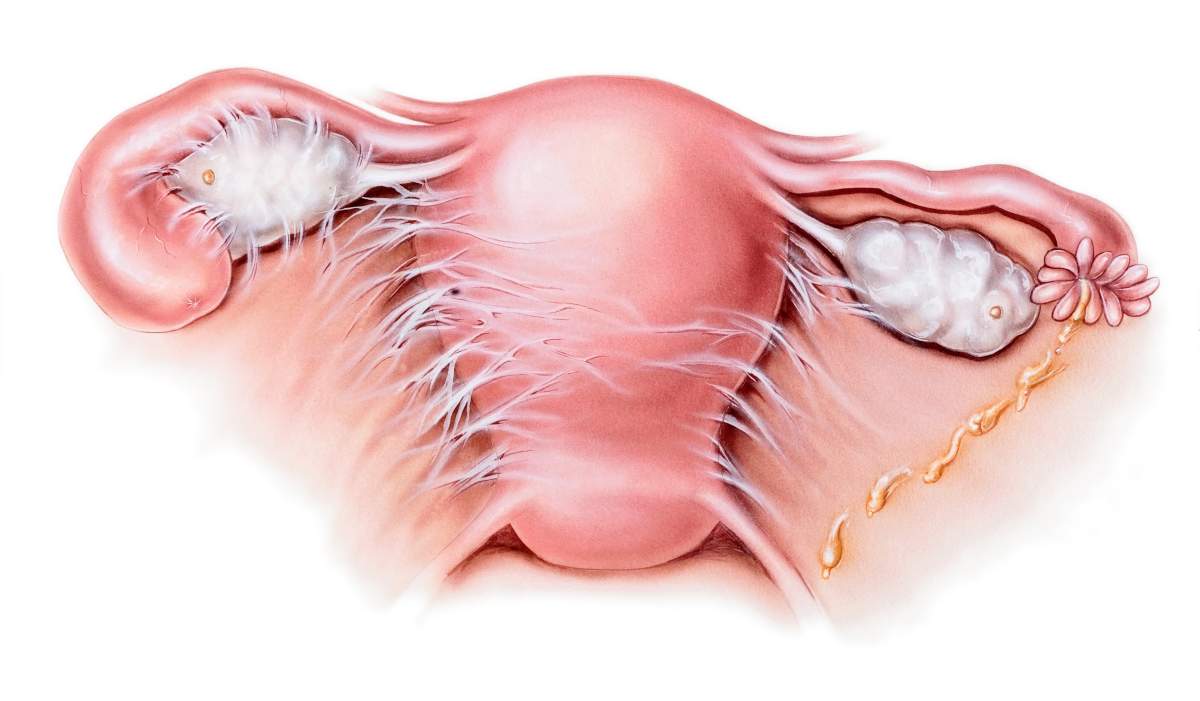 Pelvic inflammatory disease (PID). PID occurs when pathogenic organisms migrate upward from the urethra and cervix into the upper genital tract. PID can lead to infertility, ectopic pregnancy, and chronic pain. Doctors often prescribe at least two broad- spectrum antibiotics for PID because it is hard to identify the organisms responsible.