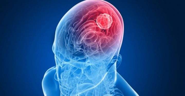 Groundbreaking brain cancer research at the University of Saskatchewan provides hope - image