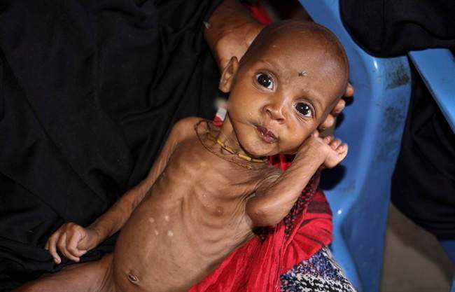 In this photo taken Saturday, Feb. 25, 2017, malnourished baby Ali Hassan, 9-months-old, is held by his mother Fadumo Abdi Ibrahim, who fled the drought in southern Somalia, at a feeding center in a camp in Mogadishu, Somalia.