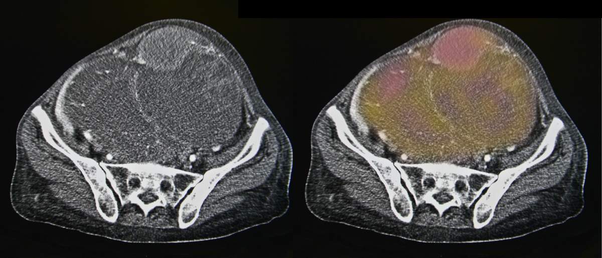 Ovarian cancer, CT.