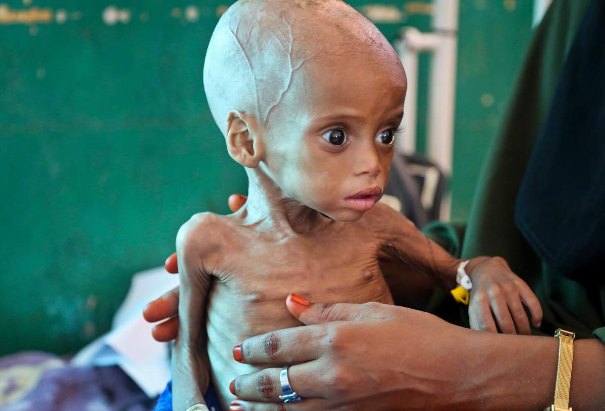 Acutely malnourished child Sacdiyo Mohamed, 9 months old, is treated at the Banadir Hospital after her mother Halima Hassan Mohamed fled the drought in southern Somalia and traveled by car to the capital Mogadishu, in Somalia Saturday, March 11, 2017. Somalia’s government has declared the drought a national disaster, and the United Nations estimates that 5 million people in this Horn of Africa nation need aid, amid warnings of a full-blown famine.