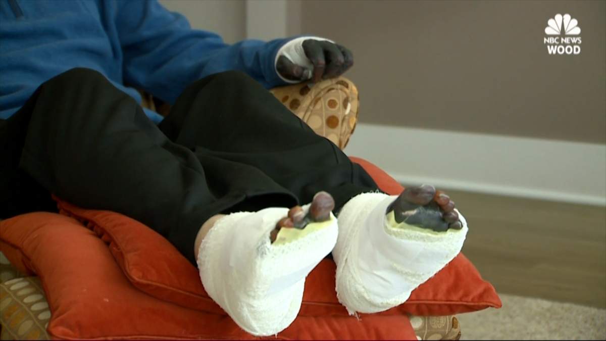 Strep throat leads to amputation of Michigan man’s hands and feet - image