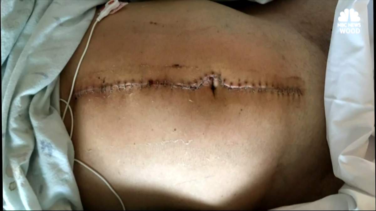 Strep throat leads to amputation of Michigan man’s hands and feet - image