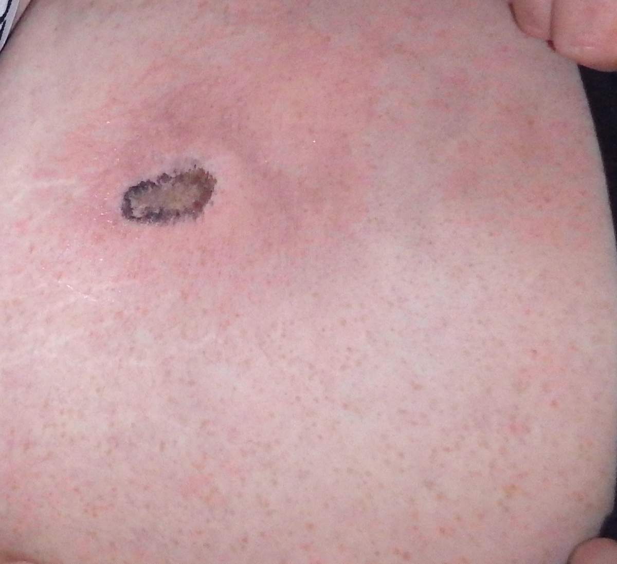 The scar Wayne Walker has been left with as a result of the battery he uses for his e-cigarette exploding in his pants.