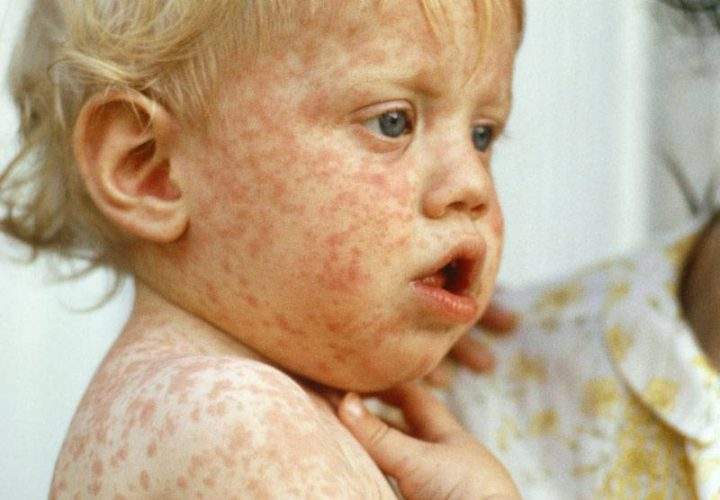 Romania's vaccination rate fell as the country's anti-vaccination movement grew. Now, it has Europe's highest measles rate (by far), and 17 children are dead. 