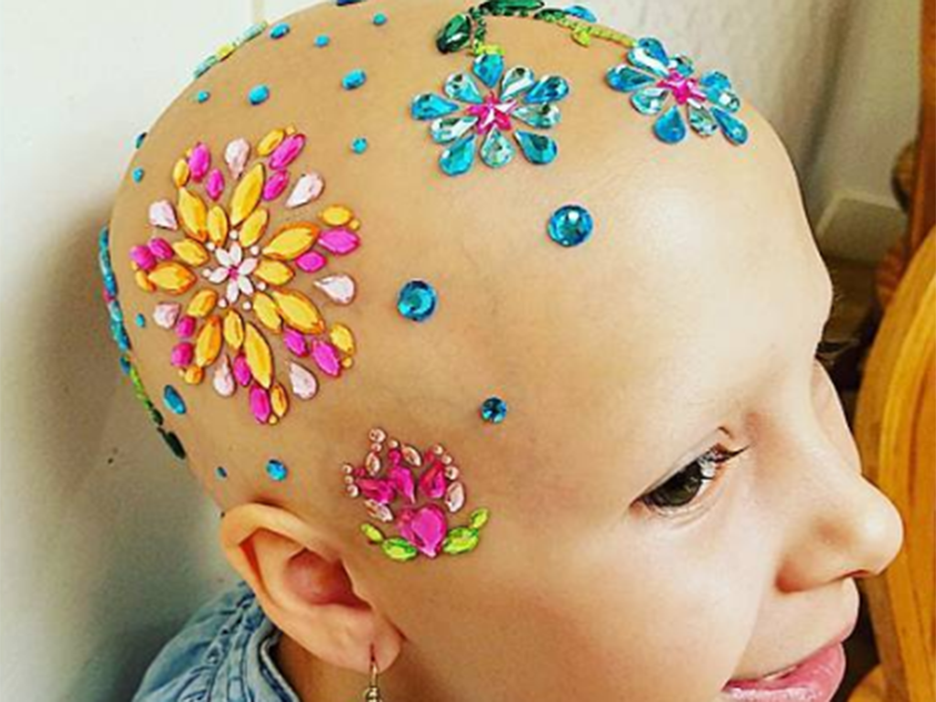 Gianessa Wride has alopecia, an autoimmune disorder that causes hair loss, but that didn't stop her from participating in 'Crazy Hair Day' at school. 