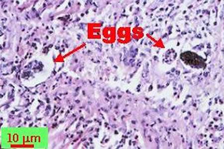 rat lungworm