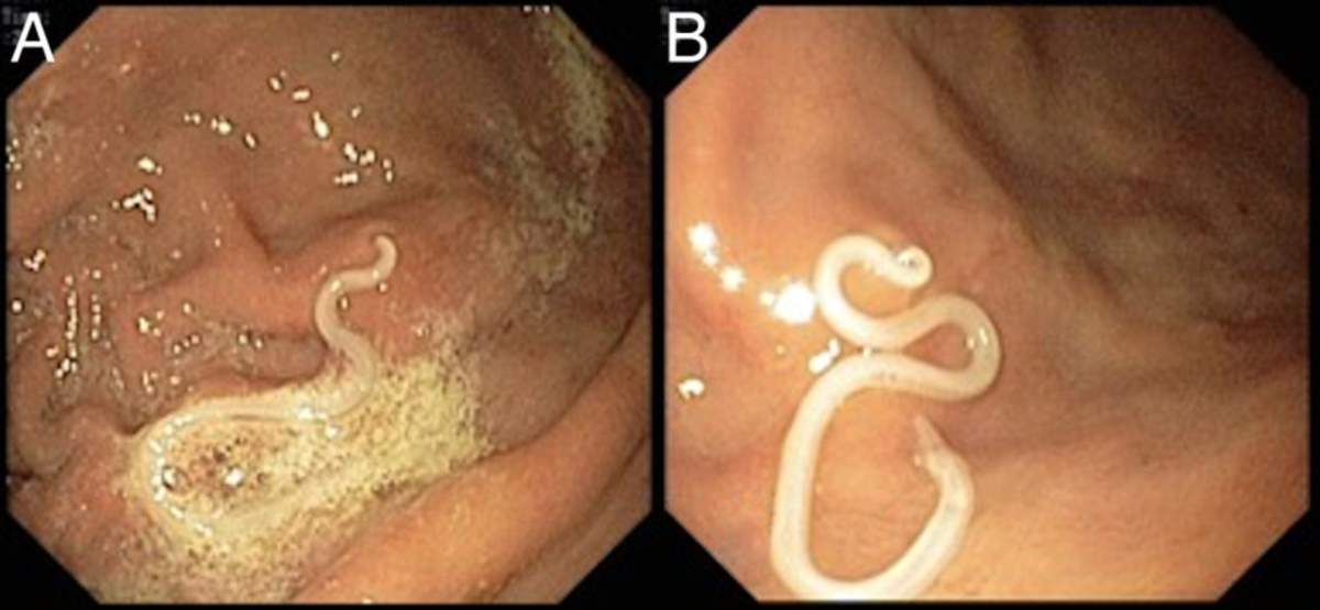 Are parasitic worms lurking in your seafood? Here’s what Canadian experts say - image