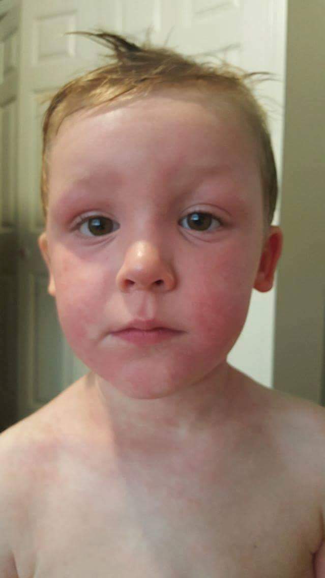 5-year-old Jakob Bowers face was red and swollen