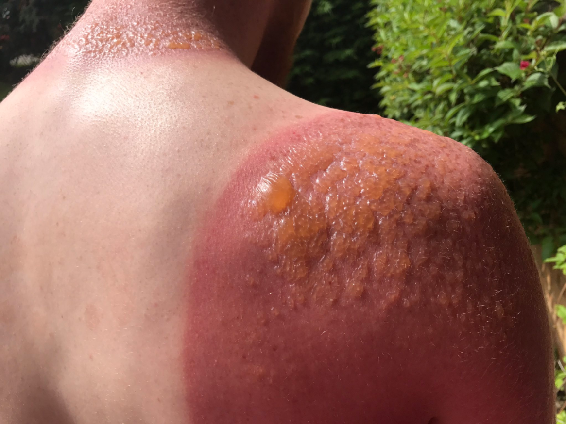 Greg Binnie of Scotland warns others about the importance of sun protection after he is left with a dangerous sunburn.