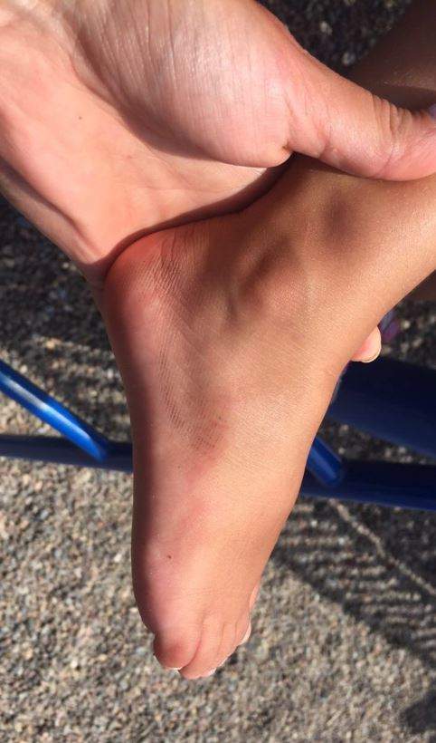Ari’s foot was run over by the vehicle in the crosswalk.