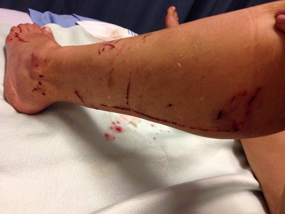 Chiarelli was left with scratches and bites up both legs, and required 10 stitches after the attack.