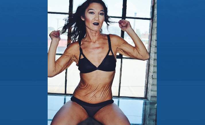 Model Sara Geurts has a rare skin condition that slows down collagen production, which results in fragile and wrinkled skin.