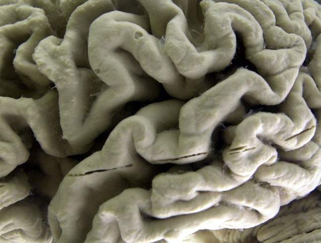 Traumatic brain injuries can increase a person's risk of developing dementia, according to a new study.