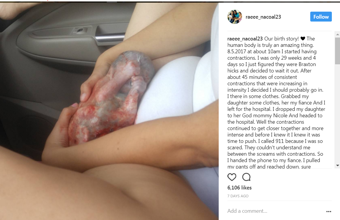 Baby prematurely born in amniotic sac, mother shares photo - image