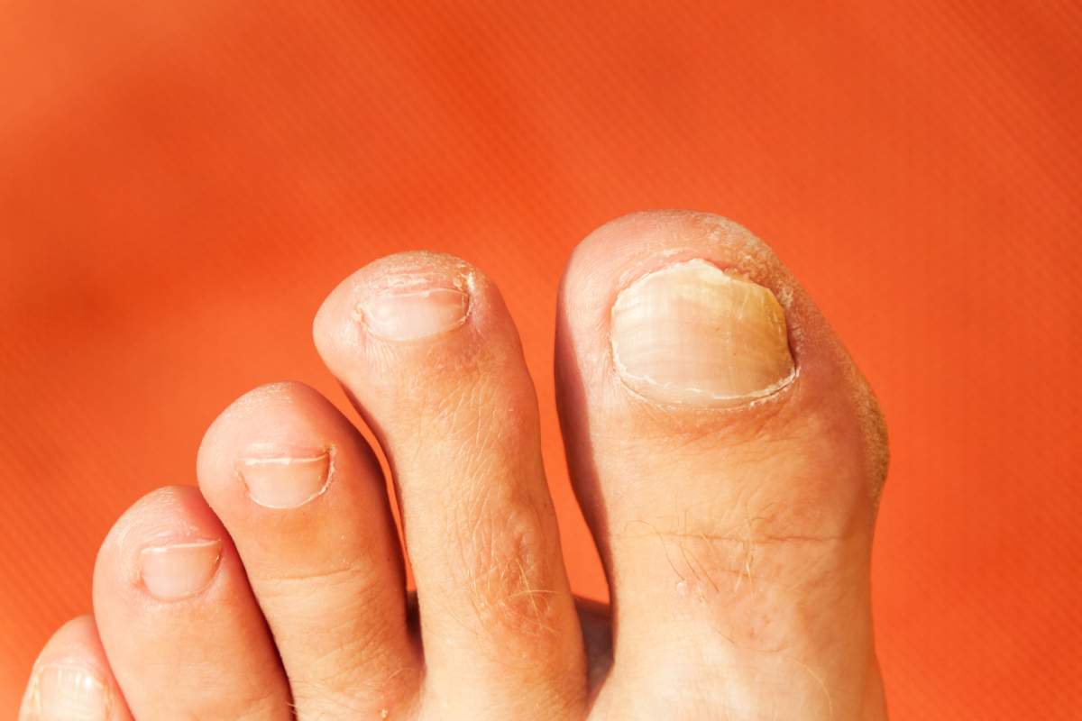toe nail fungus