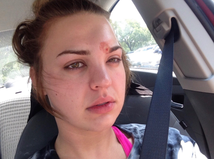 Katie Wright wants others to know the importance of cleaning makeup brushes after contracting a staph infection.