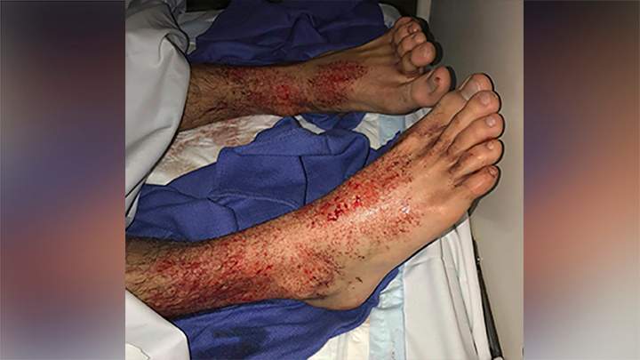 Sam Kanizay’s feet are seen covered in what looked like hundreds of bleeding little pin holes. A teenager who went for a swim at a Melbourne beach and emerged with his feet covered in blood has stumped marine experts.