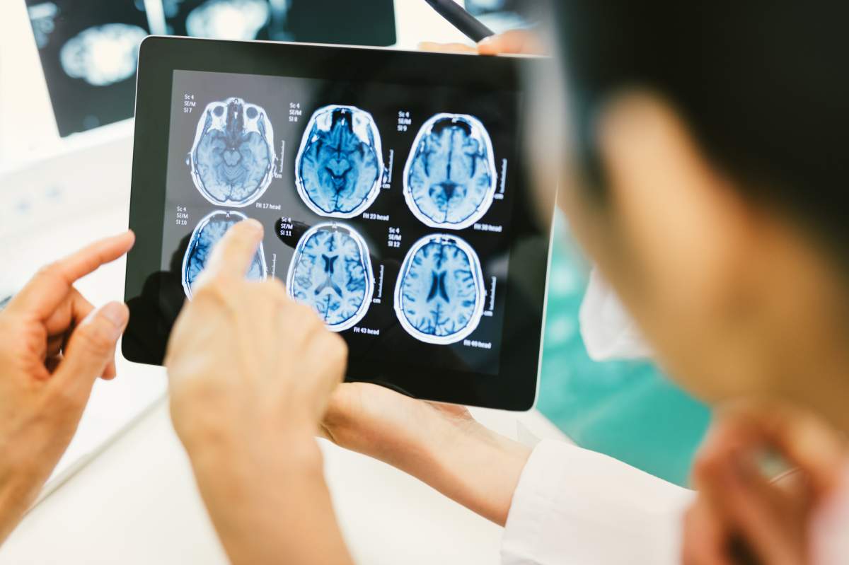 File photo of doctors looking at a brain scan.