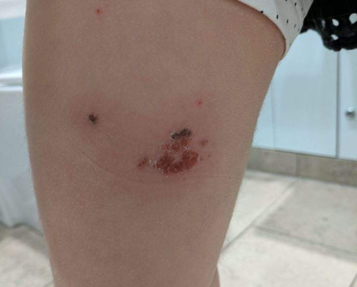 Bedbug bites are seen on Molly Reid’s thigh in this undated handout photo.