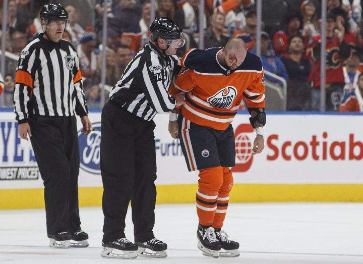 Edmonton Oilers’ Zack Kassian (44) is bleeding after a fight against Calgary Flames’ Tanner Glass (15) during first period NHL action in Edmonton, Alta., on Wednesday October 4, 2017.