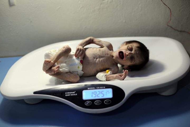 A Syrian infant suffering from severe malnutrition at a clinic in the rebel-controlled town of Hamouria, in the eastern Ghouta region on the outskirts of the capital Damascus, on Oct. 21, 2017.