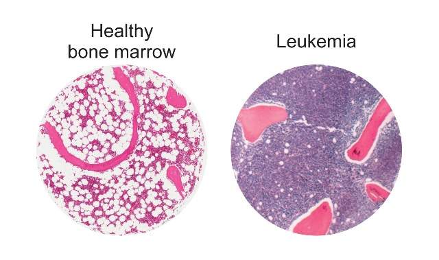 Fat cells (white circles) in healthy human bone marrow, left, compared to bone marrow in a patient with leukemia, right.