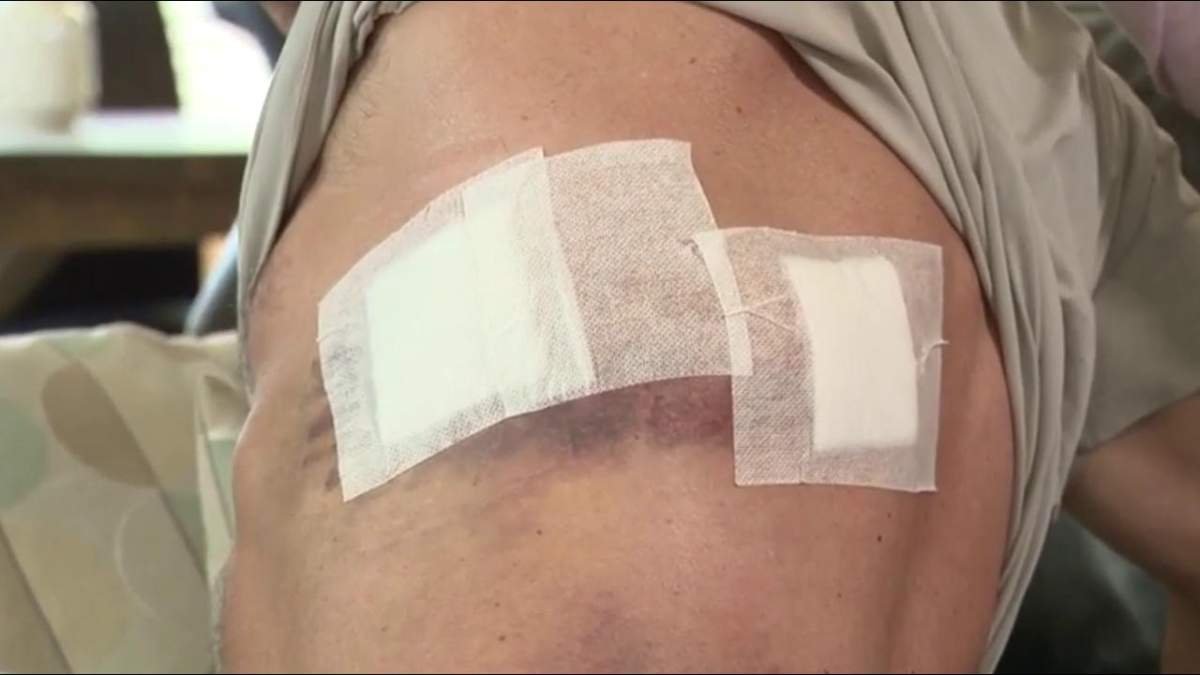 Surrey man Kevin Sears shows the place where he took a fragmented bullet in Las Vegas during the shooting on Oct. 1.