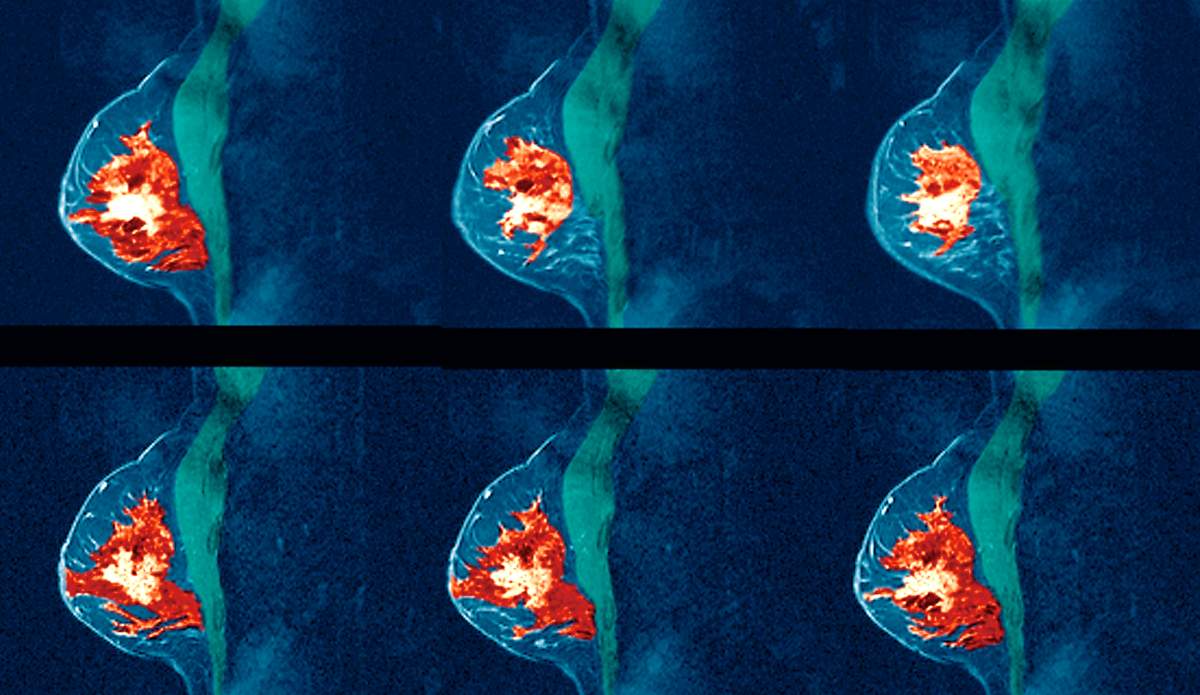breast cancer returns
