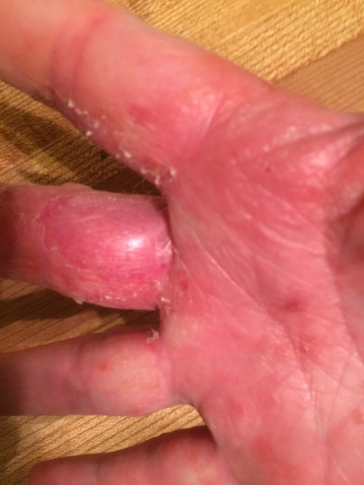 Pustular skin disorder causes hands to swell and blister.