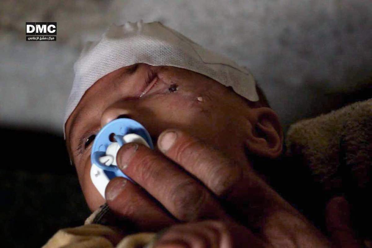 In this file his photo provided on Monday, Dec. 18, 2017 by the Syrian anti-government activist group Damascus Media Center, which has been authenticated based on its contents and other AP reporting, shows Karim, an infant from the besieged Eastern Ghouta suburb of Damascus, who was injured weeks ago in a government bombing of the market of his hometown.