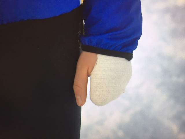Natalie Wilkie lost four fingers on her left hand in an industrial accident 18 months ago.
