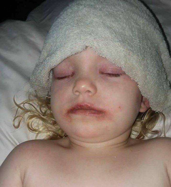 Lydia Cravens, 3, in hospital following a severe allergic reaction to a kid's makeup kit.